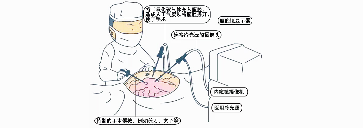 腹腔鏡攝像機(jī)使用步驟及注意事項(xiàng)